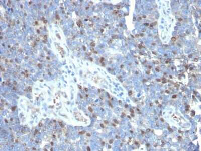 Immunohistochemistry-Paraffin: ROR gamma/RORC/NR1F3 Antibody (RORC/2941) [NBP3-08314] - Formalin-fixed, paraffin-embedded human colon carcinoma stained with ROR gamma/RORC/NR1F3 Mouse Monoclonal Antibody (RORC/2941).