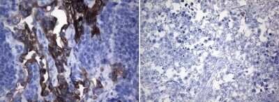 Immunohistochemistry: ROS Antibody (OTI1A1) - Azide and BSA Free [NBP2-73933] - Staining of paraffin-embedded HCC78 (left) and HeLa (right) xenograft using TA805804 (0.2ug/ml). (Heat-induced epitope retrieval by 1mM EDTA in 10mM Tris buffer (pH8.0) at 120C for 3min).