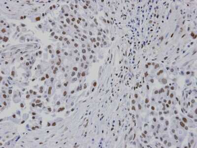 Immunohistochemistry-Paraffin: RPA14 Antibody [NBP1-32023] - Paraffin-embedded lung CA patient tumor, using antibody at 1:100 dilution.