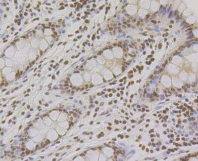 Immunohistochemistry: RPA2 Antibody (JE45-59) [NBP2-76888] - Immunohistochemical analysis of paraffin-embedded human colon tissue using anti-RPA32/RPA2 antibody. The section was pre-treated using heat mediated antigen retrieval with Tris-EDTA buffer (pH 8.0-8.4) for 20 minutes. The tissues were blocked in 5% BSA for 30 minutes at room temperature, washed with ddH2O and PBS, and then probed with the antibody at 1/200 dilution, for 30 minutes at room temperature and detected using an HRP conjugated compact polymer system. DAB was used as the chrogen. Counter stained with hematoxylin and mounted with DPX.