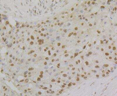 Immunohistochemistry: RPA2 Antibody (JE45-59) [NBP2-76888] - Immunohistochemical analysis of paraffin-embedded human breast cancer tissue using anti-RPA32/RPA2 antibody. The section was pre-treated using heat mediated antigen retrieval with Tris-EDTA buffer (pH 8.0-8.4) for 20 minutes. The tissues were blocked in 5% BSA for 30 minutes at room temperature, washed with ddH2O and PBS, and then probed with the antibody at 1/200 dilution, for 30 minutes at room temperature and detected using an HRP conjugated compact polymer system. DAB was used as the chrogen. Counter stained with hematoxylin and mounted with DPX.