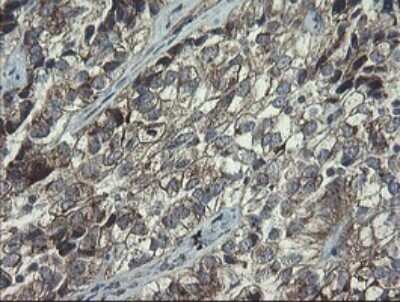 Immunohistochemistry: RPC62 Antibody (OTI2H1) - Azide and BSA Free [NBP2-73942] - Analysis of Adenocarcinoma of Human ovary tissue.