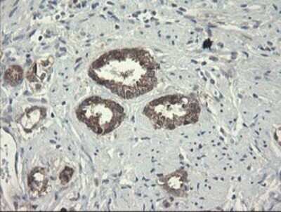 Immunohistochemistry: RPC62 Antibody (OTI2H1) - Azide and BSA Free [NBP2-73942] - Analysis of Carcinoma of Human prostate tissue.