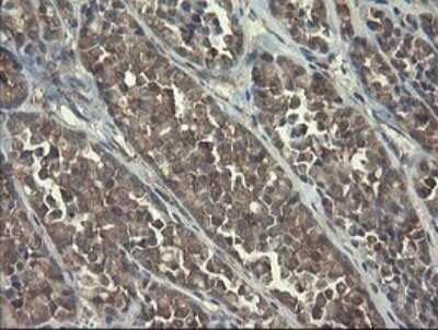 Immunohistochemistry: RPC62 Antibody (OTI2H1) - Azide and BSA Free [NBP2-73942] - Analysis of Carcinoma of Human thyroid tissue.