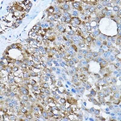 Immunohistochemistry-Paraffin: RPL36 Antibody [NBP2-94161] - Immunohistochemistry of paraffin-embedded human liver cancer using RPL36 Rabbit pAb (NBP2-94161) at dilution of 1:200 (40x lens). Perform high pressure antigen retrieval with 10 mM citrate buffer pH 6.0 before commencing with IHC staining protocol.