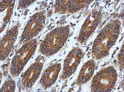 Immunohistochemistry-Paraffin: RPL9 Antibody [NBP2-20219] - Immunohistochemical analysis of paraffin-embedded Colon ca, using antibody at 1:500 dilution.