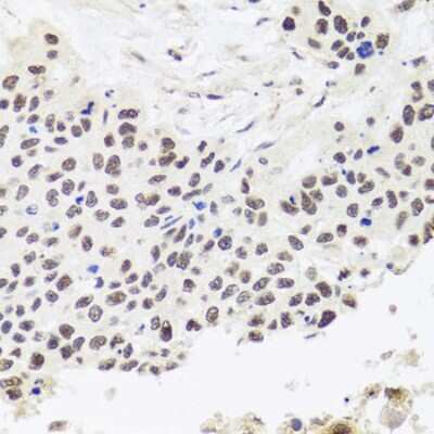 Immunohistochemistry-Paraffin: RPP30 Antibody [NBP2-94695] - Paraffin-embedded human lung cancer using RPP30 .