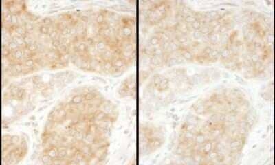 <b>Biological Strategies Validation. </b>Immunohistochemistry-Paraffin: RPS11 Antibody [NBP2-22289] - Samples: FFPE serial sections of human breast carcinoma. Antibody: Affinity purified rabbit anti- RPS11 used at a dilution of 1:1,000 (1ug/ml). Detection: DAB. Counterstain: Hematoxylin (blue).