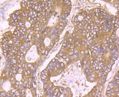 Immunohistochemistry-Paraffin: RPS19 Antibody (JU33-43) [NBP2-75649] - Analysis of paraffin-embedded human colon cancer tissue using anti-RPS19 antibody. Counter stained with hematoxylin.