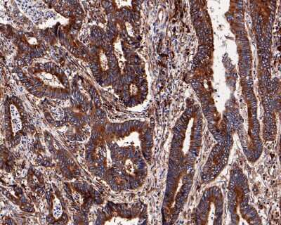 Immunohistochemistry-Paraffin: RPS20 Antibody (SC65-08) [NBP2-67628] - Analysis of paraffin-embedded human colon carcinoma tissue with Rabbit anti-RPS20 antibody washed with ddH2O and PBS, and then probed with the primary antibody  at 1/200 dilution for 1 hour at room temperature. The detection was performed using an HRP conjugated compact polymer system. DAB was used as the chromogen. Tissues were counterstained with hematoxylin and mounted with DPX.