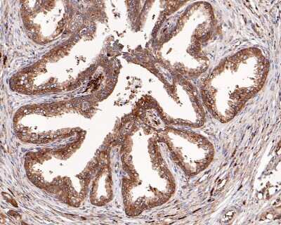 Immunohistochemistry-Paraffin: RPS20 Antibody (SC65-08) [NBP2-67628] - Analysis of paraffin-embedded human prostate carcinoma tissue with Rabbit anti-RPS20 antibody washed with ddH2O and PBS, and then probed with the primary antibody  at 1/200 dilution for 1 hour at room temperature. The detection was performed using an HRP conjugated compact polymer system. DAB was used as the chromogen. Tissues were counterstained with hematoxylin and mounted with DPX.