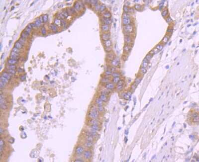 Immunohistochemistry-Paraffin: RPSA Antibody (JF0955) [NBP2-67117] - Analysis of paraffin-embedded human gastric carcinoma tissue using anti-RPSA antibody. Counter stained with hematoxylin.