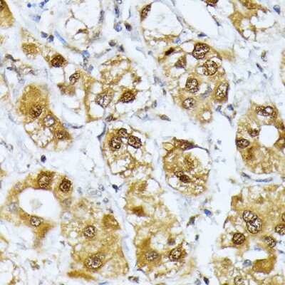 Immunohistochemistry-Paraffin: RRAGD Antibody [NBP2-93833] - Paraffin-embedded human liver cancer using RRAGD .