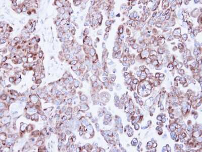 Immunohistochemistry-Paraffin: RRBP1 Antibody [NBP1-32813] - OVCAR3 xenograft, using Ribosome binding protein 1 antibody at 1:500 dilution. Antigen Retrieval: Trilogy™ (EDTA based, pH 8.0) buffer, 15min