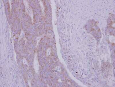 Immunohistochemistry-Paraffin: RRM1 Antibody [NBP2-20231] - Human colon carcinoma, using RRM1 antibody at 1:500 dilution. Antigen Retrieval: Trilogy™ (EDTA based, pH 8.0) buffer, 15min.