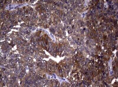 Immunohistochemistry: RRM1 Antibody (OTI5G5) - Azide and BSA Free [NBP2-73947] - Analysis of Adenocarcinoma of Human endometrium tissue. (Heat-induced epitope retrieval by 10mM citric buffer, pH6.0, 120C for 3min)