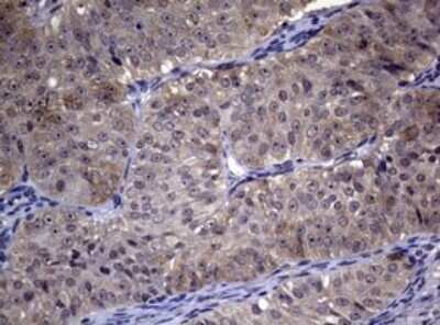 Immunohistochemistry: RRM1 Antibody (OTI5G5) - Azide and BSA Free [NBP2-73947] - Analysis of Adenocarcinoma of Human ovary tissue. (Heat-induced epitope retrieval by 10mM citric buffer, pH6.0, 120C for 3min)