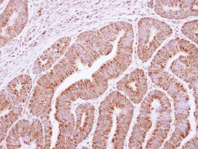 Immunohistochemistry-Paraffin: RRP4 Antibody [NBP2-20235] - Immunohistochemical analysis of paraffin-embedded Colon ca, using antibody at 1:250 dilution.