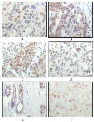 Immunohistochemistry-Paraffin: RSK1 Antibody (10B1D7A9) [NBP1-47405] - Analysis of human esophageal squamous cell carcinoma (A), colon adenocarcinoma (B), liver carcinoma (C), skin carcinoma (D), breast ductal tumor (E) and brain tumor (F), showing nuclear localization using RSK1 mouse mAb with DAB staining.