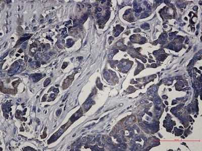 Immunohistochemistry-Paraffin: RSK1 Antibody (S02-2D2) [NBP3-20053] - Immunohistochemistry of RSK1 in paraffin-embedded Human Cholangiocarcinoma using NBP3-20053 at dilution 1/50