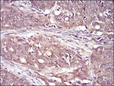 Immunohistochemistry-Paraffin: RSK3 Antibody (3C4C8) [NBP2-52555] - Analysis of paraffin-embedded cervical cancer tissues using RPS6KA2 mouse mAb with DAB staining.