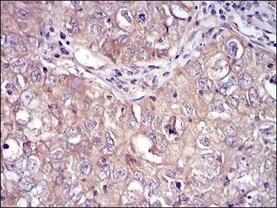 Immunohistochemistry-Paraffin: RSK3 Antibody (3C4C8) [NBP2-52555] - Analysis of paraffin-embedded lung cancer tissues using RPS6KA2 mouse mAb with DAB staining.