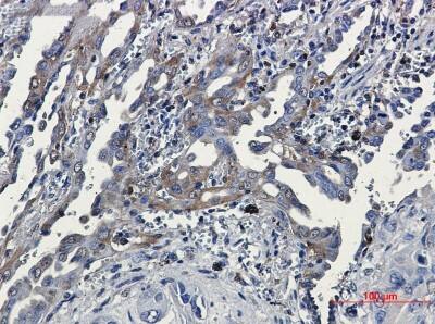 Immunohistochemistry-Paraffin: RSK3 Antibody (S05-5E4) [NBP3-19811] - Immunohistochemical of RSK3 in Human lung cancer tissue using RSK3 antibody at dilution 1/20