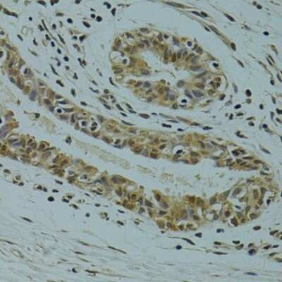 Immunohistochemistry-Paraffin: RSRC1 Antibody [NBP2-93020] - Human breast cancer using RSRC1 antibody at dilution of 1:100 (40x lens).