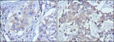 Immunohistochemistry: RTN3 Antibody (10A8) [NBP1-47353] - Immunohistochemical analysis of paraffin-embedded human lung cancer (left) and breast cancer (right) using anti-RTN3 antibody with DAB staining.