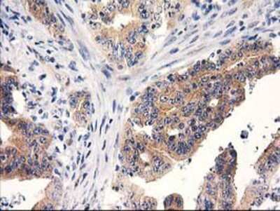 Immunohistochemistry-Paraffin: RTN4IP1 Antibody (3B2) [NBP2-00478] - Staining of paraffin-embedded Adenocarcinoma of Human colon tissue using anti-RTN4IP1 mouse monoclonal antibody.