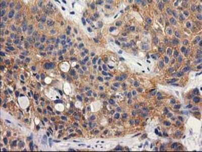 Immunohistochemistry-Paraffin: RTN4IP1 Antibody (3B2) [NBP2-00478] - Staining of paraffin-embedded Carcinoma of Human bladder tissue using anti-RTN4IP1 mouse monoclonal antibody.