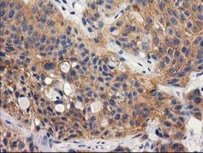 Immunohistochemistry: RTN4IP1 Antibody (OTI3B2) - Azide and BSA Free [NBP2-73952] - Staining of paraffin-embedded Carcinoma of Human bladder tissue using anti-RTN4IP1 mouse monoclonal antibody.