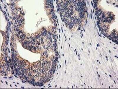 Immunohistochemistry: RTN4IP1 Antibody (OTI3B2) - Azide and BSA Free [NBP2-73952] - Staining of paraffin-embedded Carcinoma of Human prostate tissue using anti-RTN4IP1 mouse monoclonal antibody.