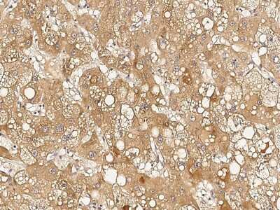 Immunohistochemistry-Paraffin: RTVP-1/GLIPR1 Antibody [NBP2-99206] - Immunochemical staining of human RTVP-1/GLIPR1 in human hepatoma with rabbit polyclonal antibody (1:1000, formalin-fixed paraffin embedded sections).