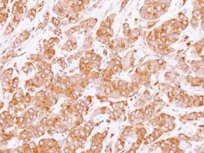 Immunohistochemistry-Paraffin: RUFY1 Antibody [NBP2-20241] - RUFY1 antibody detects RUFY1 protein at cytoplasm on human breast cancer by immunohistochemical analysis. Sample: Paraffin-embedded breast cancer. RUFY1 antibody dilution: 1:250.