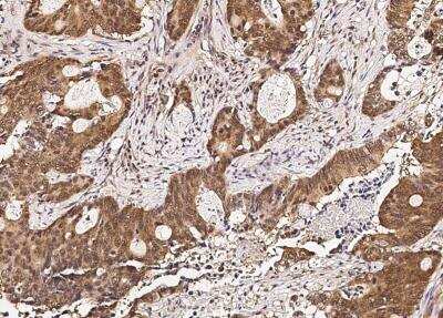 Immunohistochemistry-Paraffin: RUVBL1 Antibody (01) [NBP3-06522] - Staining of human RUVBL1 in human colon carcinoma with mouse monoclonal antibody (1:100000).