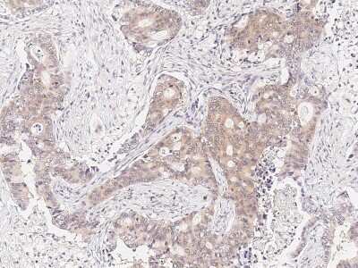 Immunohistochemistry-Paraffin: RUVBL1 Antibody [NBP2-99030] - Immunochemical staining of human RUVBL1 in human colon carcinoma with rabbit polyclonal antibody (1:1000, formalin-fixed paraffin embedded sections).