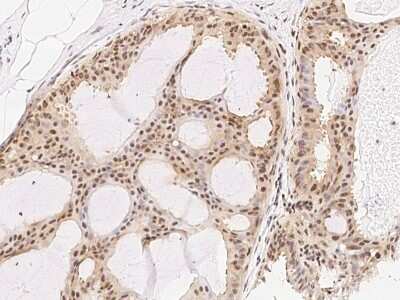 Immunohistochemistry-Paraffin: RXR gamma/NR2B3 Antibody [NBP2-98864] - Staining of human RXR gamma/NR2B3 in human breast carcinoma with rabbit polyclonal antibody (1:1000).