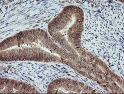 Immunohistochemistry: RYBP/DEDAF Antibody (OTI1B2) - Azide and BSA Free [NBP2-73961] - Staining of paraffin-embedded Adenocarcinoma of Human endometrium tissue using anti-RYBP/DEDAF mouse monoclonal antibody.