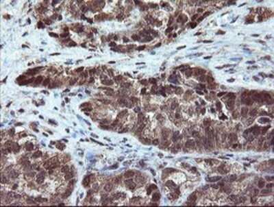 Immunohistochemistry: RYBP/DEDAF Antibody (OTI1B2) - Azide and BSA Free [NBP2-73961] - Staining of paraffin-embedded Adenocarcinoma of Human ovary tissue using anti-RYBP/DEDAF mouse monoclonal antibody.