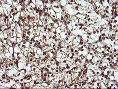 Immunohistochemistry: RYBP/DEDAF Antibody (OTI1B2) - Azide and BSA Free [NBP2-73961] - Staining of paraffin-embedded Carcinoma of Human kidney tissue using anti-RYBP/DEDAF mouse monoclonal antibody.