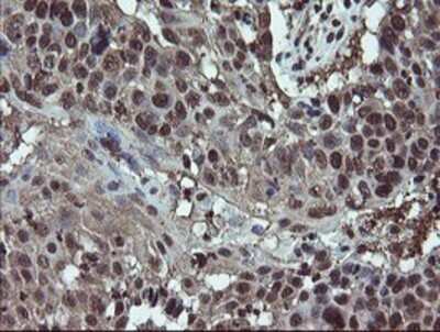 Immunohistochemistry: RYBP/DEDAF Antibody (OTI1B2) - Azide and BSA Free [NBP2-73961] - Staining of paraffin-embedded Carcinoma of Human lung tissue using anti-RYBP/DEDAF mouse monoclonal antibody.