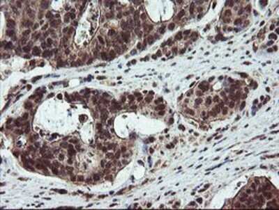 Immunohistochemistry: RYBP/DEDAF Antibody (OTI1B2) - Azide and BSA Free [NBP2-73961] - Staining of paraffin-embedded Carcinoma of Human pancreas tissue using anti-RYBP/DEDAF mouse monoclonal antibody.