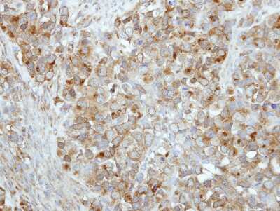 Immunohistochemistry-Paraffin: Rab17 Antibody [NBP2-20036] - Immunohistochemical analysis of paraffin-embedded H661 xenograft, using antibody at 1:500 dilution.