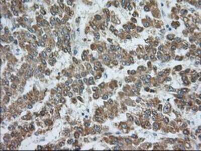 Immunohistochemistry: Rab17 Antibody (OTI5E2) - Azide and BSA Free [NBP2-73765] - Staining of paraffin-embedded Carcinoma of Human liver tissue using anti-Rab17 mouse monoclonal antibody.