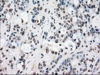 Immunohistochemistry: Rad9 Antibody (OTI7B11) - Azide and BSA Free [NBP2-73783] - Staining of paraffin-embedded Adenocarcinoma of colon tissue using anti-Rad9 mouse monoclonal antibody.