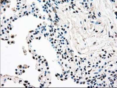 Immunohistochemistry: Rad9 Antibody (OTI7B11) - Azide and BSA Free [NBP2-73783] - Staining of paraffin-embedded Carcinoma of lung tissue using anti-Rad9 mouse monoclonal antibody.