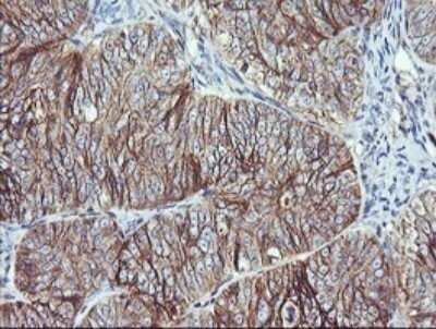 Immunohistochemistry: RalB Antibody (OTI2C4) - Azide and BSA Free [NBP2-73785] - Analysis of Adenocarcinoma of Human ovary tissue. (Heat-induced epitope retrieval by 10mM citric buffer, pH6.0, 120C for 3min)