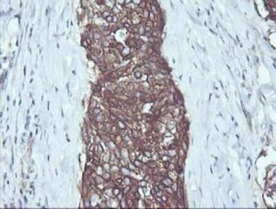 Immunohistochemistry: RalB Antibody (OTI2C4) - Azide and BSA Free [NBP2-73785] - Analysis of Carcinoma of Human lung tissue. (Heat-induced epitope retrieval by 10mM citric buffer, pH6.0, 120C for 3min)