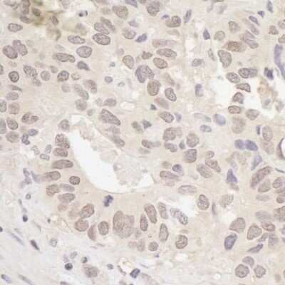 Western Blot: RanBP1 Antibody [NB100-79815] - Detection of human RanBP1 by immunohistochemistry. Sample: FFPE section of human colon carcinoma. Antibody: Affinity purified rabbit anti- RanBP1 (NB100-79815). Detection: DAB